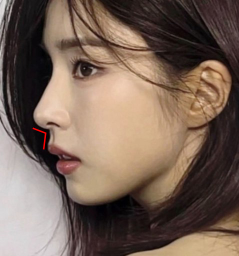 Apgujeong Seoul Plastic Surgery: The Effect of Nasolabial Angle Rhinoplasty (Shin Se-kyung, Minji) image 3