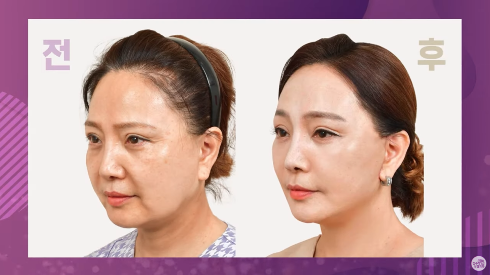 [안면거상술 - 동안성형] 압구정서울성형외과에 9년만에 찾아 온 인연! 관련 이미지 5