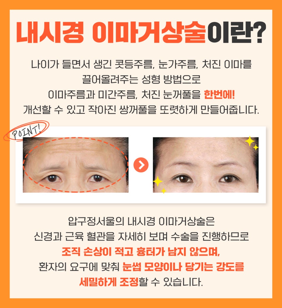압구정 이마거상 여자 이마거상 효과 내시경이마거상술 전후 사례 이마주름 원인 관련 이미지 1