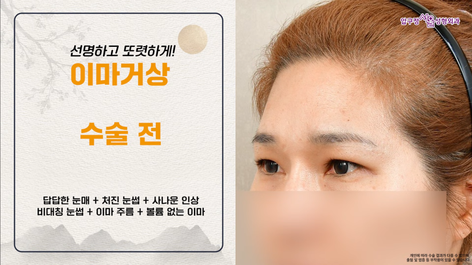 40대 이마거상수술 전후 궁금하다면? 내시경 이마거상술 체크포인트 관련 이미지 4