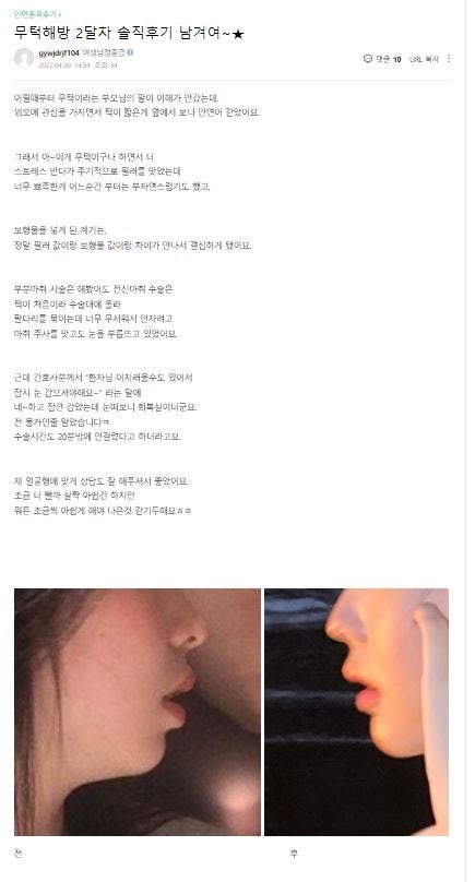 [윤곽성형] 무턱탈출, 이제 압구정서울성형외과에서! 관련 이미지 9