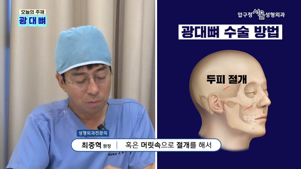 Types of Zygoma Reduction Surgery, Contour Surgery That Can Correct a Peanut-Shaped Face | Apgujeong Seoul Plastic Surgery image 5