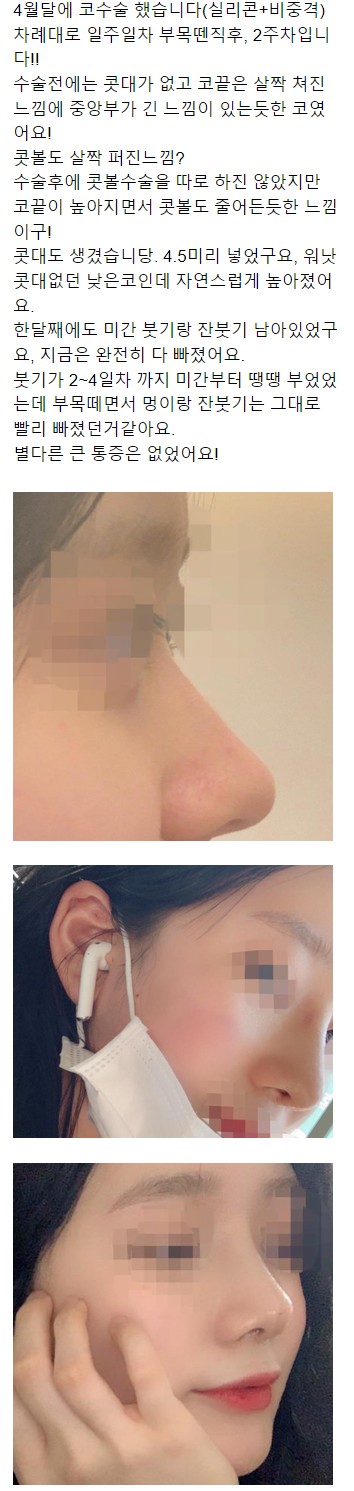 Escape from a Low Nasal Bridge at Apgujeong Seoul Plastic Surgery! image 6
