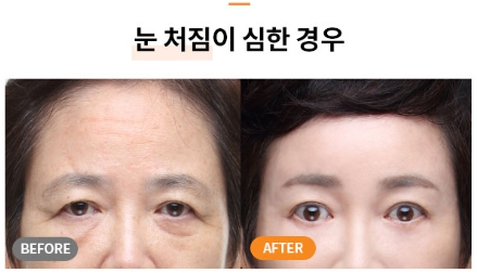 Worried About Forehead Wrinkles? A Quick Overview of Men’s Forehead Lifts and Forehead Lift Surgery Costs image 10