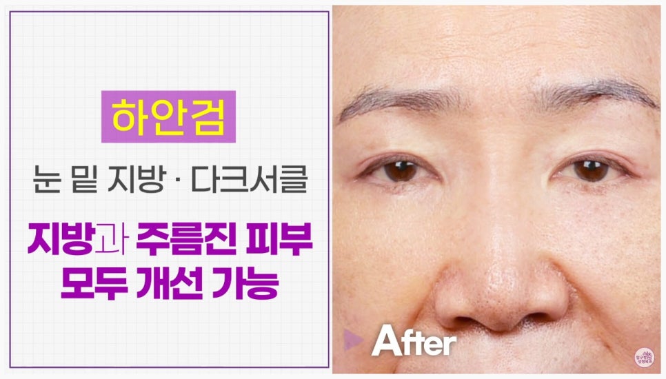 [Aging Eye Plastic Surgery in Apgujeong] Upper and Lower Blepharoplasty for a Youthful Eye Appearance! image 7