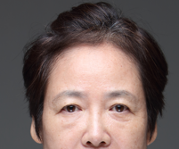 A Dramatic Transformation for Brighter, Clearer Eyes: A 5-Year Follow-Up Review of Forehead Lift Surgery in Your 60s image 3