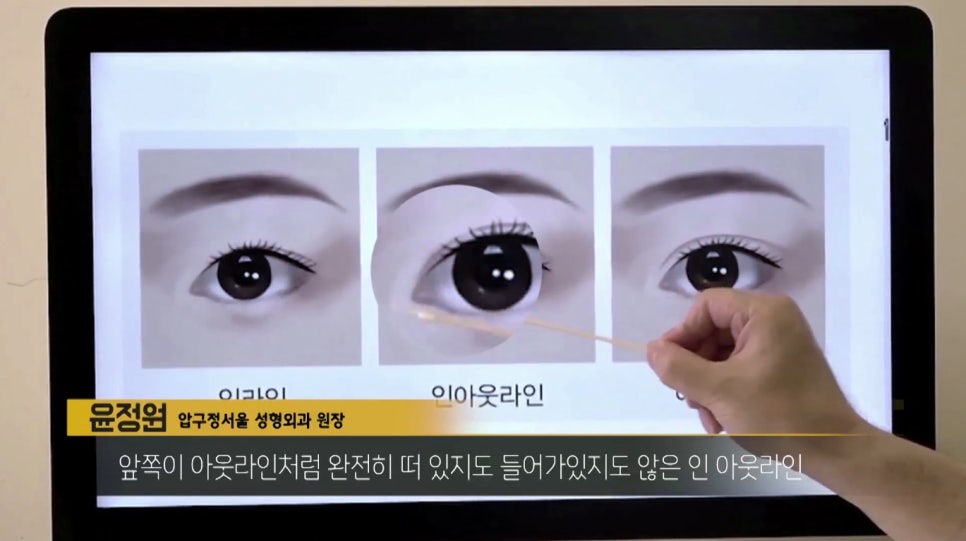 압구정서울성형외과 "눈성형" 그것이 알고싶다! 관련 이미지 4