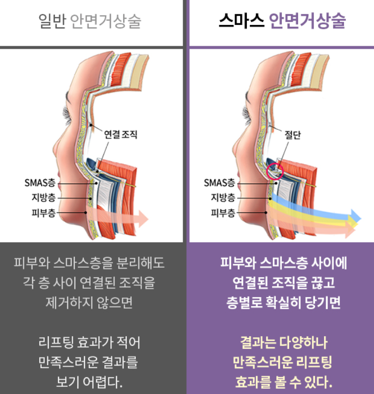 "SMAS Facelift" to Firmly Restore Sagging Jowls and Nasolabial Folds image 4