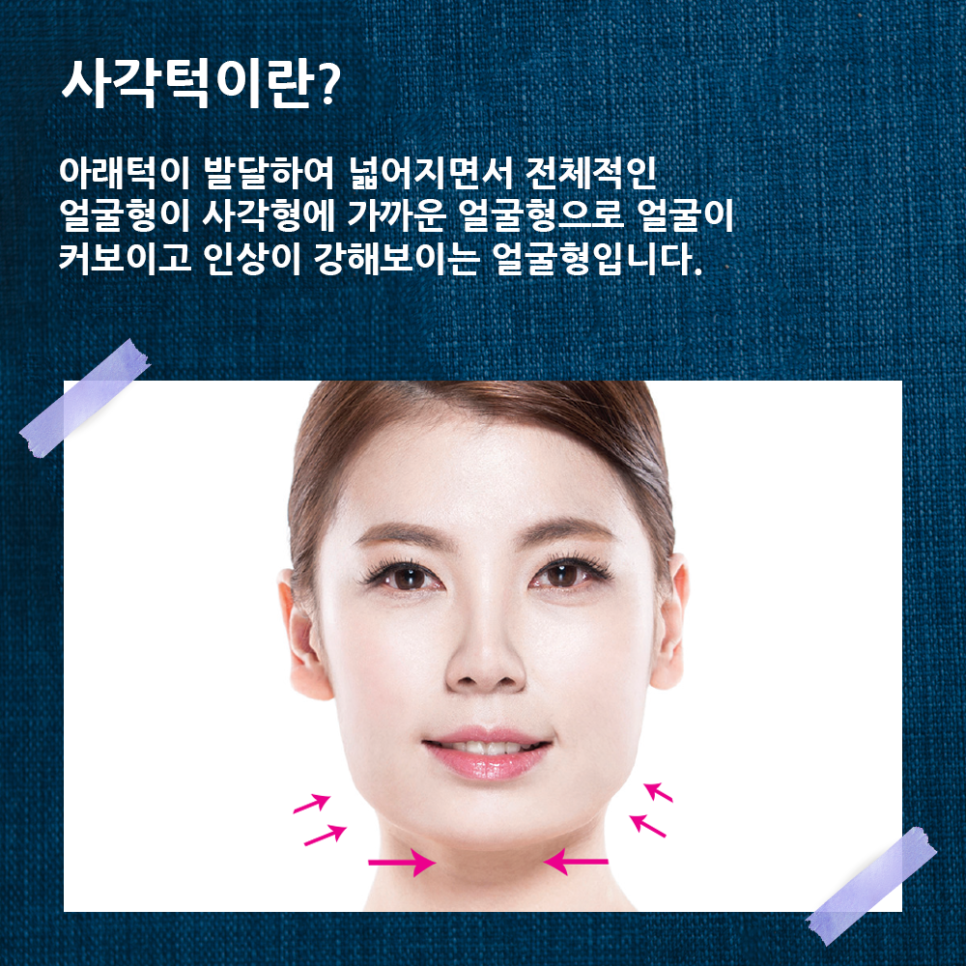 압구정서울성형외과 사각턱이 고민이라면? 클릭! 관련 이미지 2