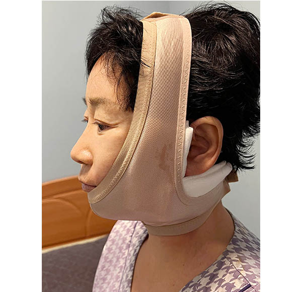 [Again, Youth Project] Consultation and Surgery Review of a Face Lift + Neck Lift in Your 60s ② image 5