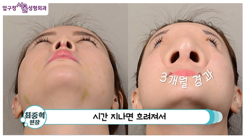 개방형 비개방형 코수술 차이점 장단점까지 한눈에 정리 관련 이미지 17