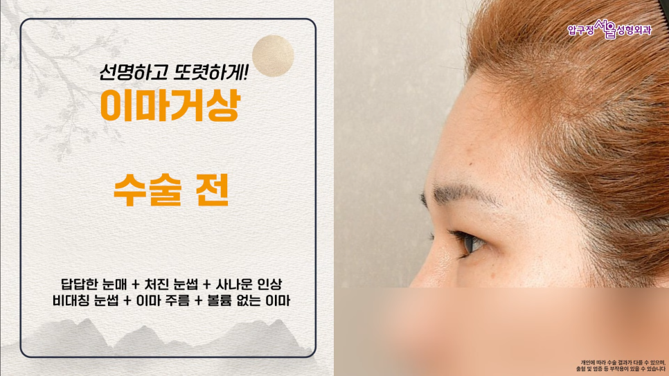 40대 이마거상수술 전후 궁금하다면? 내시경 이마거상술 체크포인트 관련 이미지 7