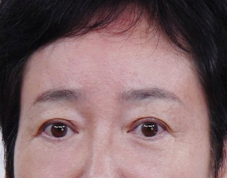 A Dramatic Transformation for Brighter, Clearer Eyes: A 5-Year Follow-Up Review of Forehead Lift Surgery in Your 60s image 14