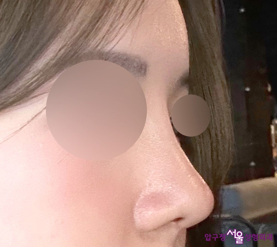 When Can Minors Preparing for College Entrance Exams Get Eye Surgery or Nose Surgery? image 12