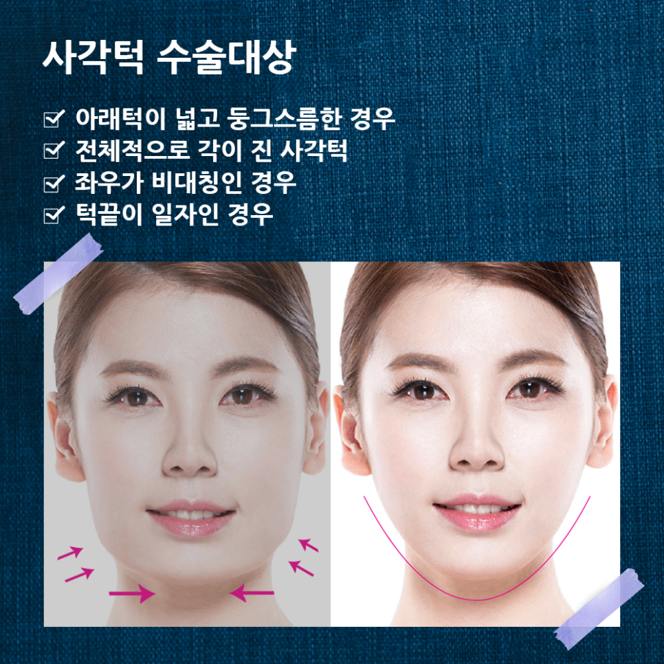 압구정서울성형외과 사각턱이 고민이라면? 클릭! 관련 이미지 3