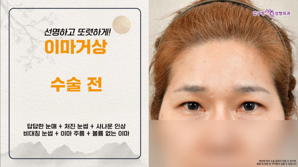 40대 이마거상수술 전후 궁금하다면? 내시경 이마거상술 체크포인트 관련 이미지 3