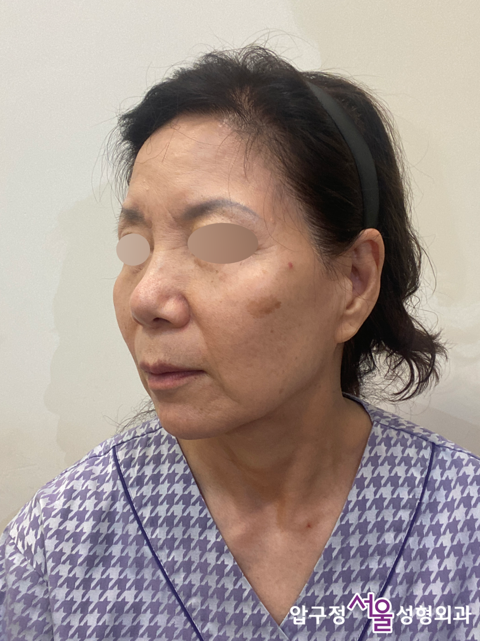 Curious About Reviews of a Clinic That Does Facelift Surgery Well at Apgujeong Seoul Plastic Surgery? image 5