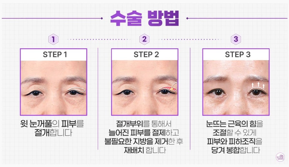 [Aging Eye Plastic Surgery in Apgujeong] Upper and Lower Blepharoplasty for a Youthful Eye Appearance! image 3