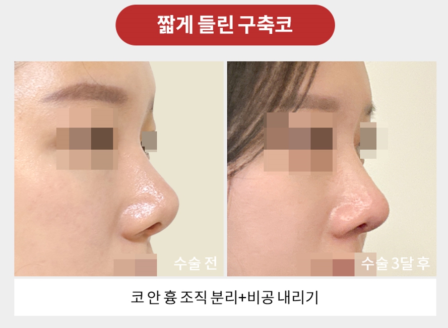 Revision Rhinoplasty Plastic Surgery: Female and Male Nose Surgery at Apgujeong Seoul Plastic Surgery image 4
