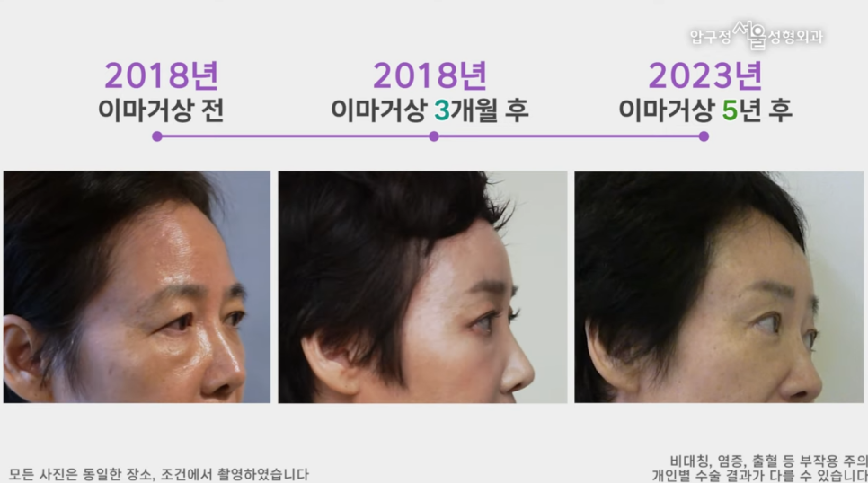[다시, 청춘 프로젝트]60대 안면거상, 목거상 3개월 경과 후기 관련 이미지 1