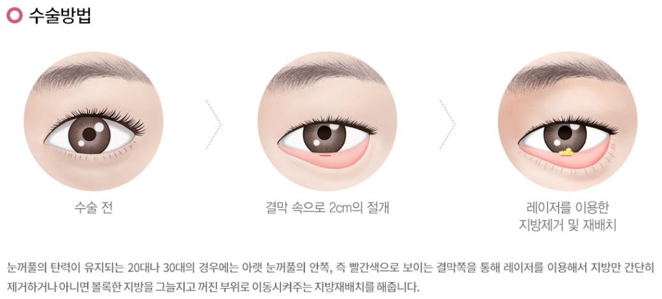 눈밑지방재배치 수술 아니어도 괜찮을 것 같죠? 관련 이미지 3