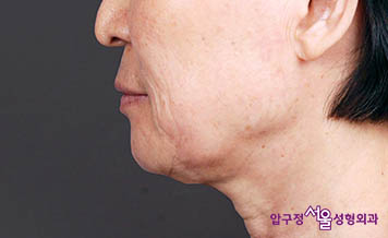 [압구정서울성형외과] 목주름과 처짐 목거상으로 깔끔한 개선! 관련 이미지 1
