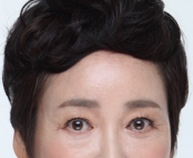 A Dramatic Transformation for Brighter, Clearer Eyes: A 5-Year Follow-Up Review of Forehead Lift Surgery in Your 60s image 13