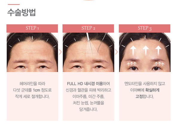 압구정서울성형 이마거상술로 이마주름 고민해결 후기 관련 이미지 4