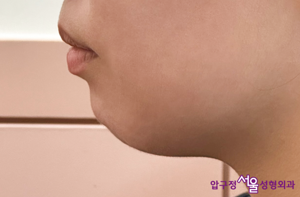 What Is a Retruded Chin? Chin Implant Surgery for Chin Correction at Apgujeong Seoul Plastic Surgery image 13