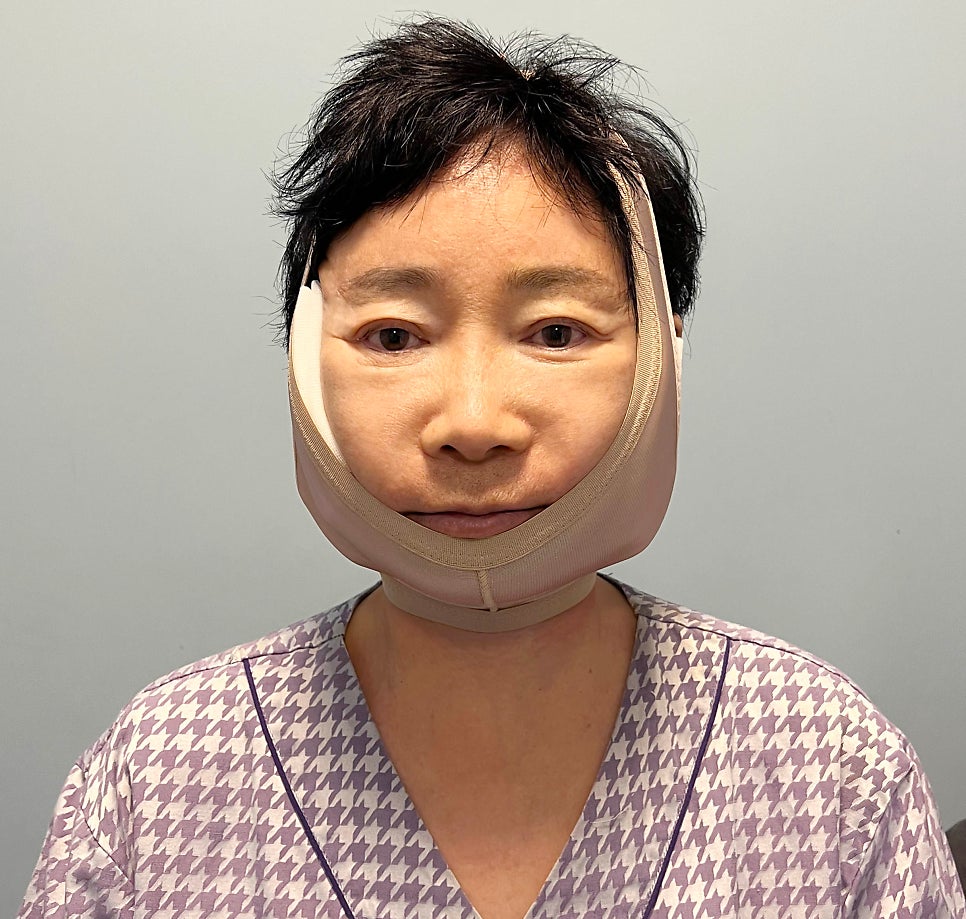 [Again, Youth Project] Consultation and Surgery Review of a Face Lift + Neck Lift in Your 60s ② image 3