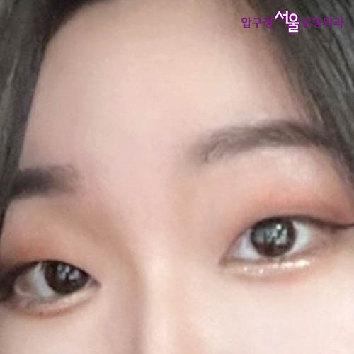 [Apgujeong Seoul Plastic Surgery] Non-incisional Eye Correction for Clearer, More Defined Eyes image 1