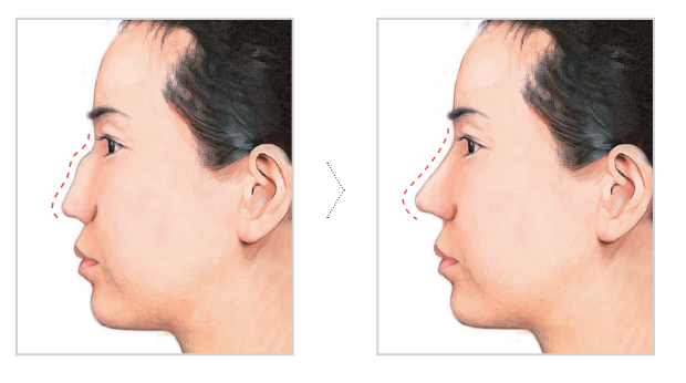 [Apgujeong Seoul Plastic Surgery] Natural Straight Line Improvement After Hump Nose Surgery! image 3