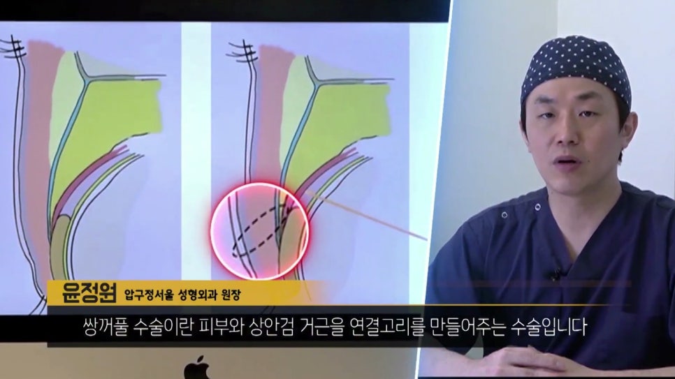 압구정서울성형외과 "눈성형" 그것이 알고싶다! 관련 이미지 5