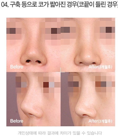Apgujeong Seoul Plastic Surgery: Revision Rhinoplasty Methods by Type and Reviews image 7