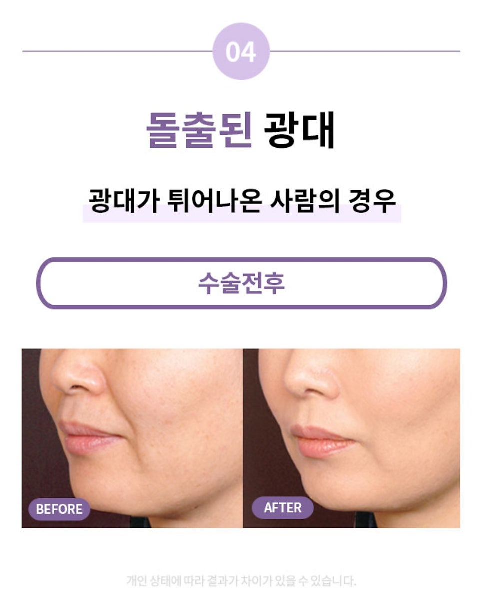 "SMAS Facelift" to Firmly Restore Sagging Jowls and Nasolabial Folds image 8