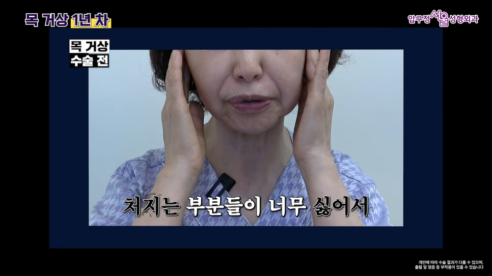 목거상 흉터 후기 목주름 수술 1년 후 변화 압구정서울성형외과 실제 사례로 알아보기 관련 이미지 3