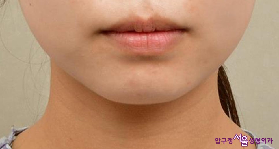 Chin Implant Surgery, a More Definitive Effect Than Fillers image 1