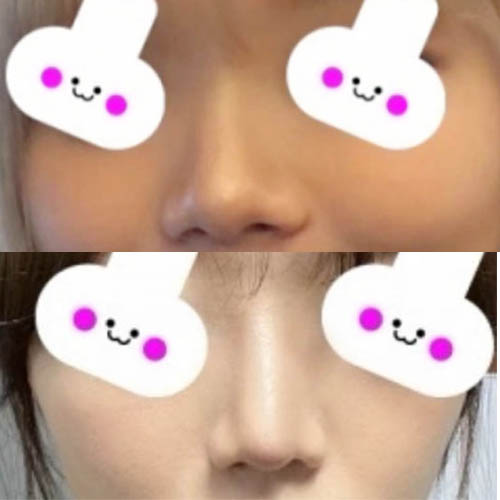Apgujeong Bulbous Nose and Straight-Bridge Line Rhinoplasty Review image 5