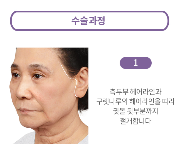 "SMAS Facelift" to Firmly Restore Sagging Jowls and Nasolabial Folds image 11