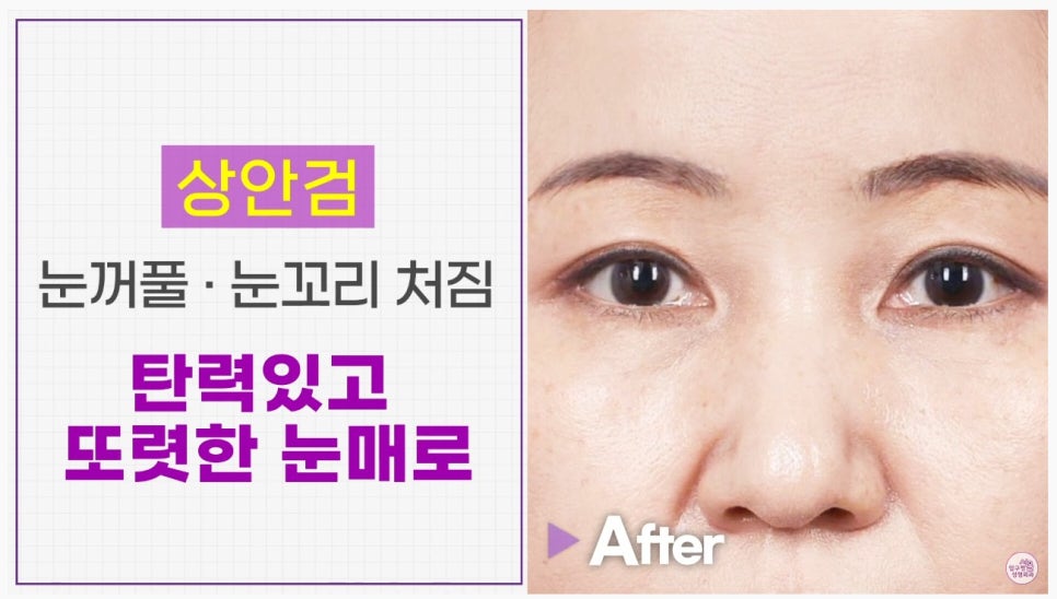 [Aging Eye Plastic Surgery in Apgujeong] Upper and Lower Blepharoplasty for a Youthful Eye Appearance! image 4