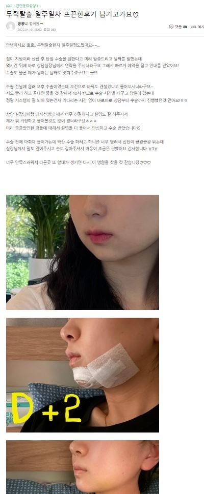 [윤곽성형] 무턱탈출, 이제 압구정서울성형외과에서! 관련 이미지 11