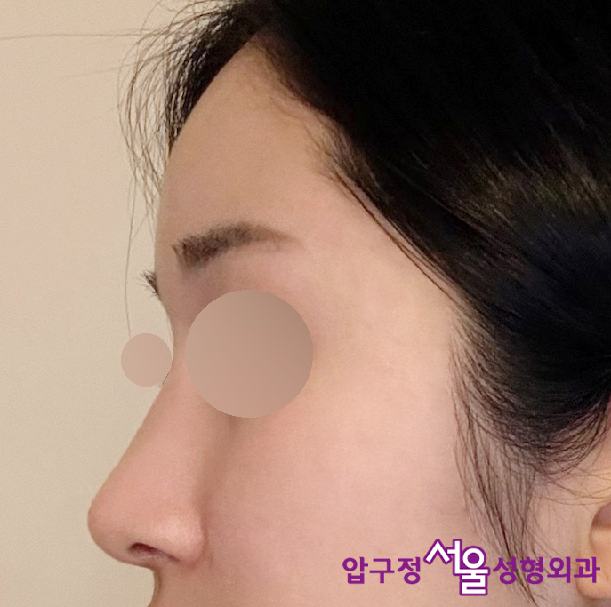 압구정 무보형물 코수술로 효과보는 매부리코 유형 관련 이미지 6