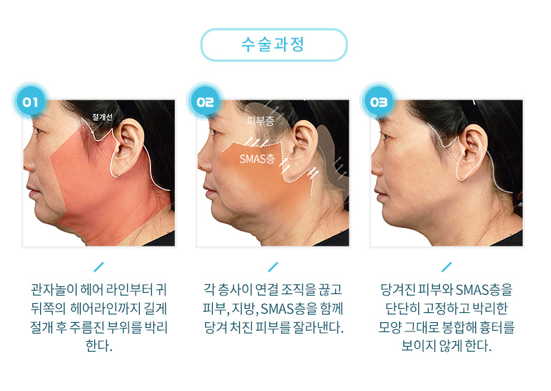 안면거상 후 주의사항 - 이건 알아야 경과가 좋져 관련 이미지 2