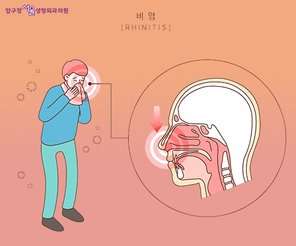 쓴생님~ 비염에도 코수술 가능한가요? 관련 이미지 1