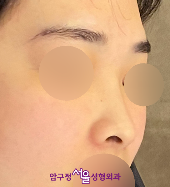 김유정 코, 눈수술(직반라인, 인아웃라인 쌍꺼풀) 연예인과 비슷하게 압구정서울성형외과 관련 이미지 7