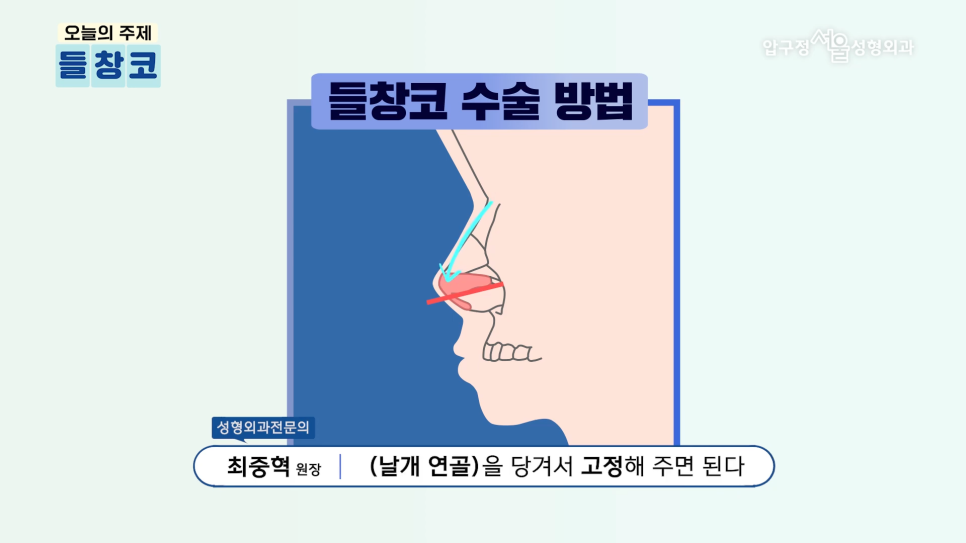 When Correction for a Saddle Nose in Apgujeong Seoul Plastic Surgery Is Needed image 5