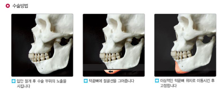[윤곽성형] 무턱탈출, 이제 압구정서울성형외과에서! 관련 이미지 3