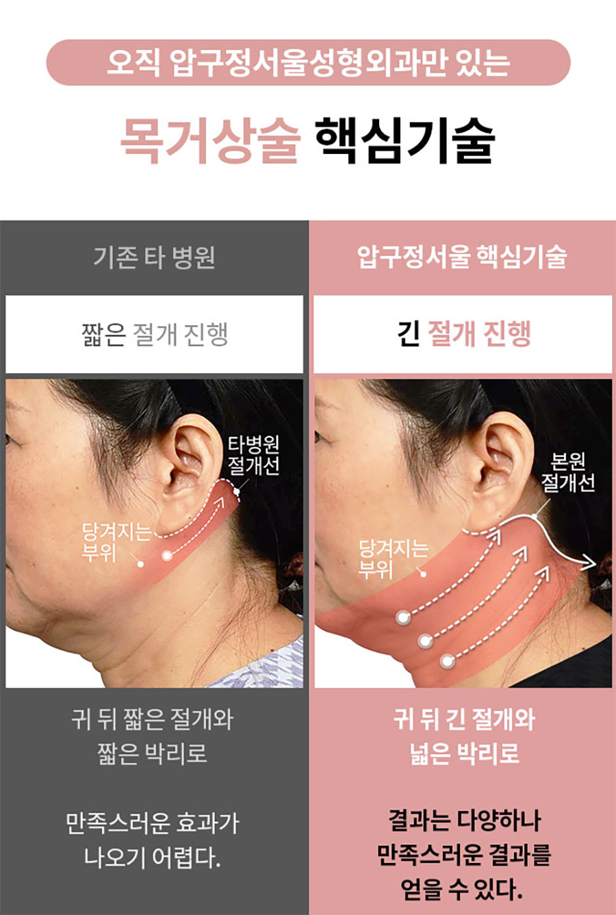 목거상 흉터 후기 목주름 수술 1년 후 변화 압구정서울성형외과 실제 사례로 알아보기 관련 이미지 8