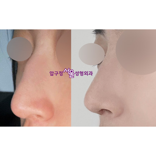 압구정 무보형물 코수술로 효과보는 매부리코 유형 관련 이미지 8