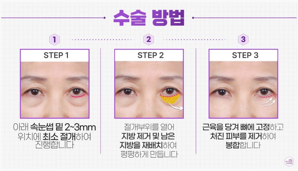 [Aging Eye Plastic Surgery in Apgujeong] Upper and Lower Blepharoplasty for a Youthful Eye Appearance! image 6
